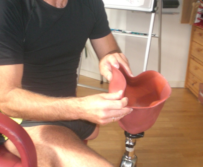 Above knee amputation flexible transfemoral socket.
